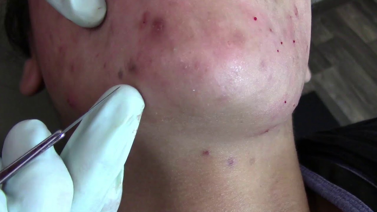 Acne Scars Treatment in Vijayawada